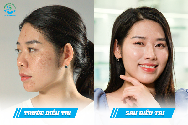 Trước & Sau