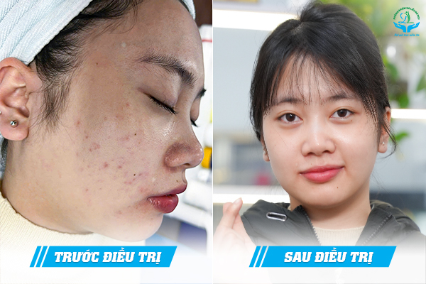 Trước & Sau