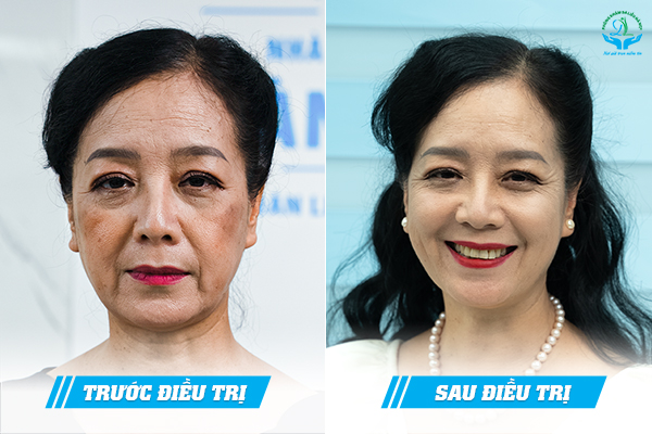 Trước & Sau