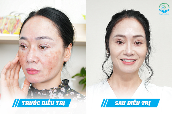 Trước & Sau
