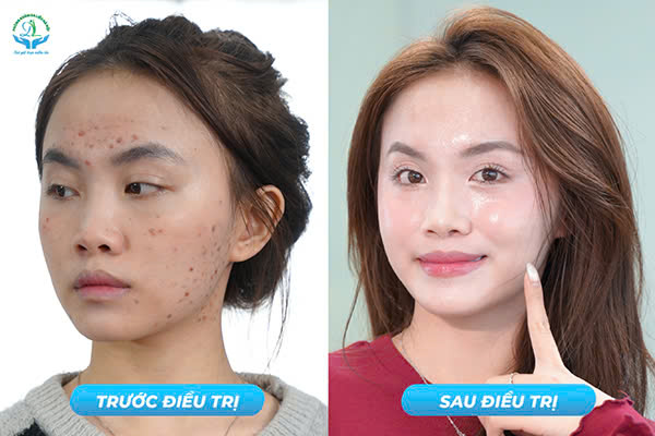 Trước & Sau