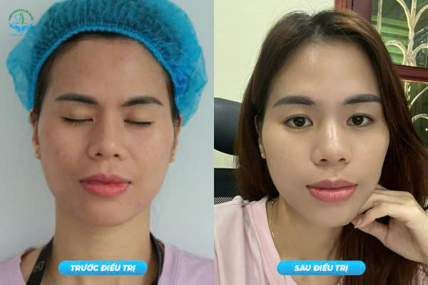 Trước & Sau