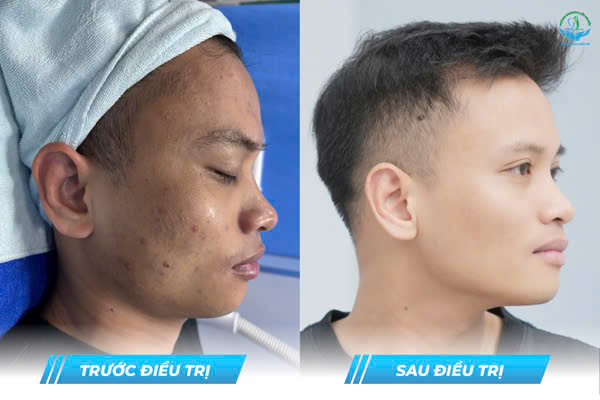 Trước & Sau